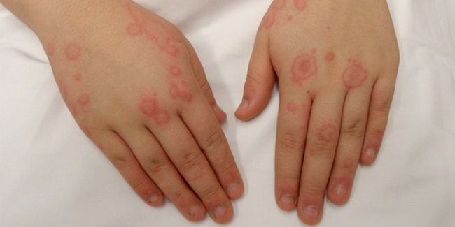 Аллергия на хомяков