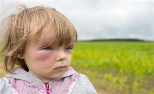 Аллергия на пыльцу у ребенка