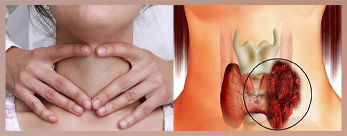Анапластический рак щитовидной железы