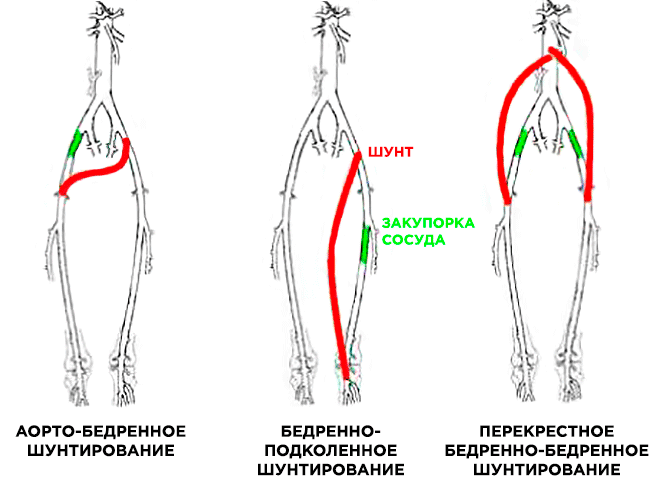 Аорто-бедренное и подколенное шунтирование