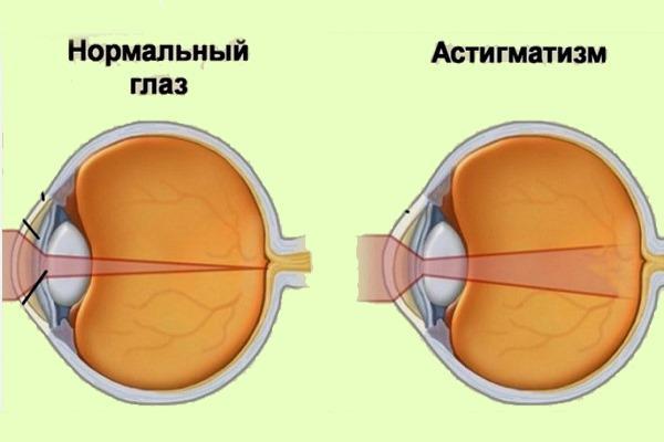 Норма и патология зрения