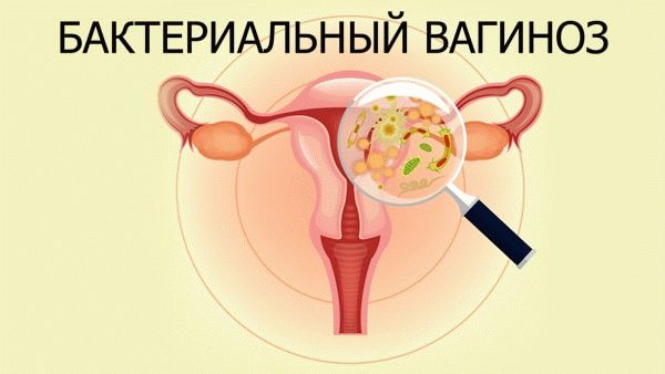 бактериальный вагиноз
