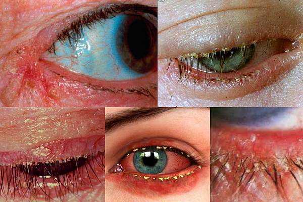 Классификация блефароконъюнктивита глаз