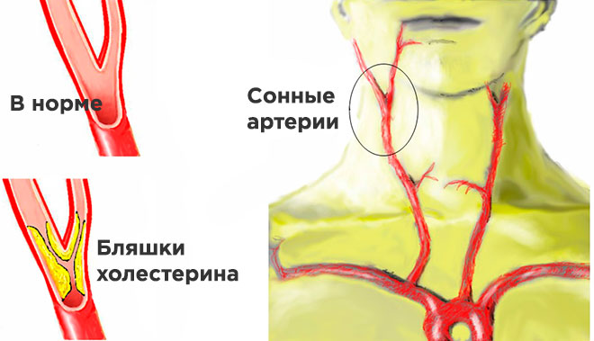 Бляшка в сонной артерии в шейном отделе