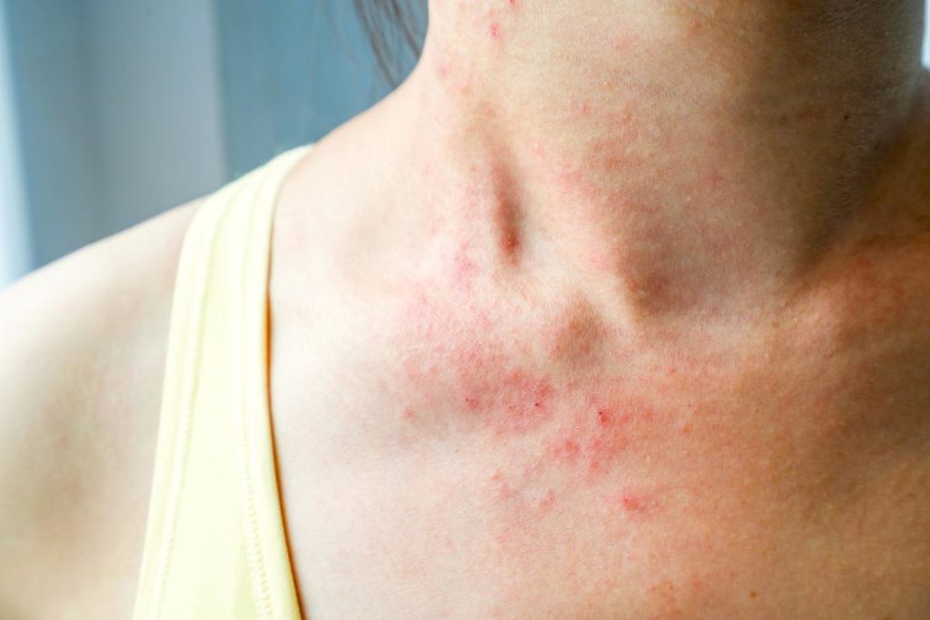 Как справиться с аллергией онкобольному в период лечения химиотерапией?