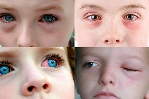 Заболевания глаз у детей