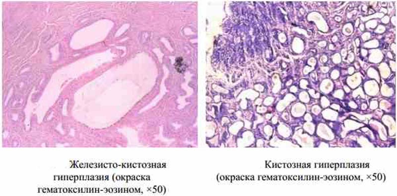 железисто-кистозная гиперплазия эндометрия