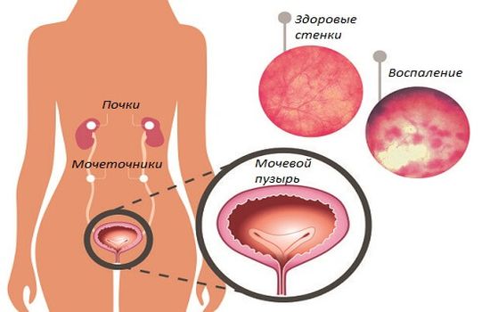 Если застудила мочевой пузырь, то какие симптомы и какое лечение?