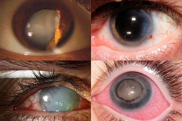Виды посттравматической катаракты по характеру повреждения