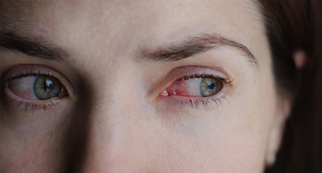 Почему может возникнуть аллергия при ношении контактных линз?