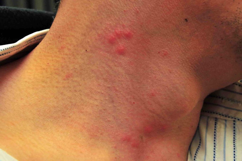 Как выглядит аллергия на клопов и её отличия от укусов насекомых