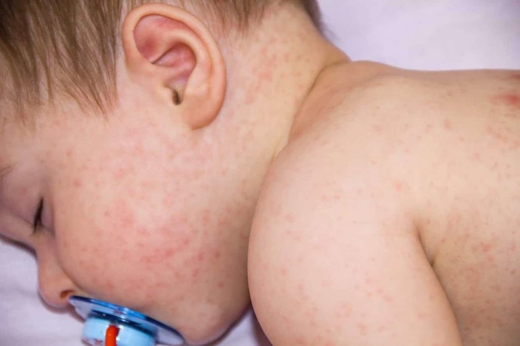 Может ли брокколи стать причиной аллергии у маленького ребёнка?