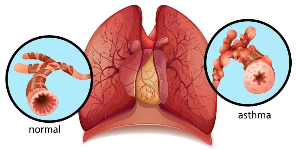 Развитие бронхиальной астмы у взрослого человека и опасность заболевания в период беременности