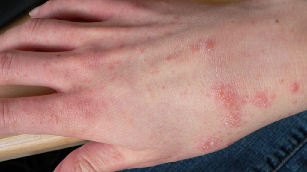 Как проявляется аллергия на антисептическое средство для рук?