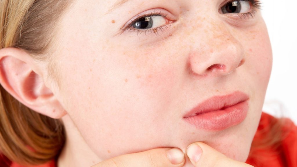 аллергия на подбородке у подростка