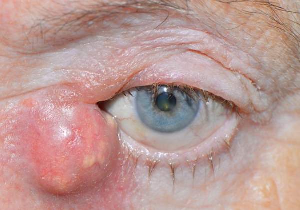 Опухший глаз при инфекции слезного канала