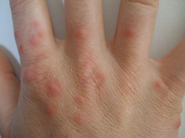 Как выглядит аллергия на клопов и её отличия от укусов насекомых