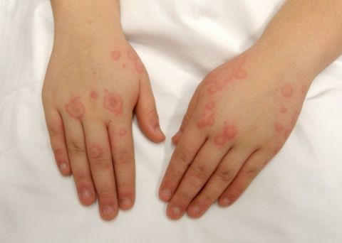 Аллергия на перчатки