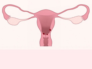 Что такое эндометриоз шейки матки