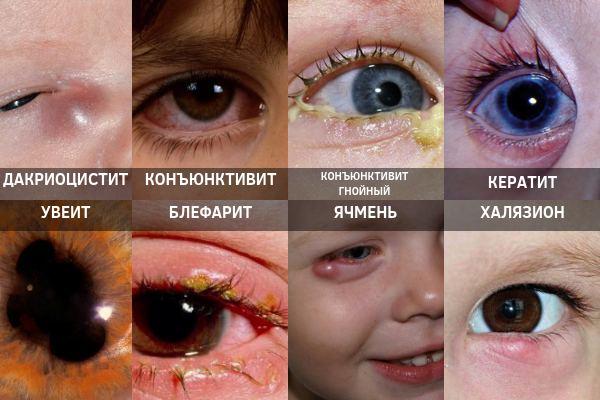 Инфекционные заболевания глаз у детей