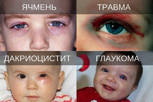 Глазные заболевания у детей