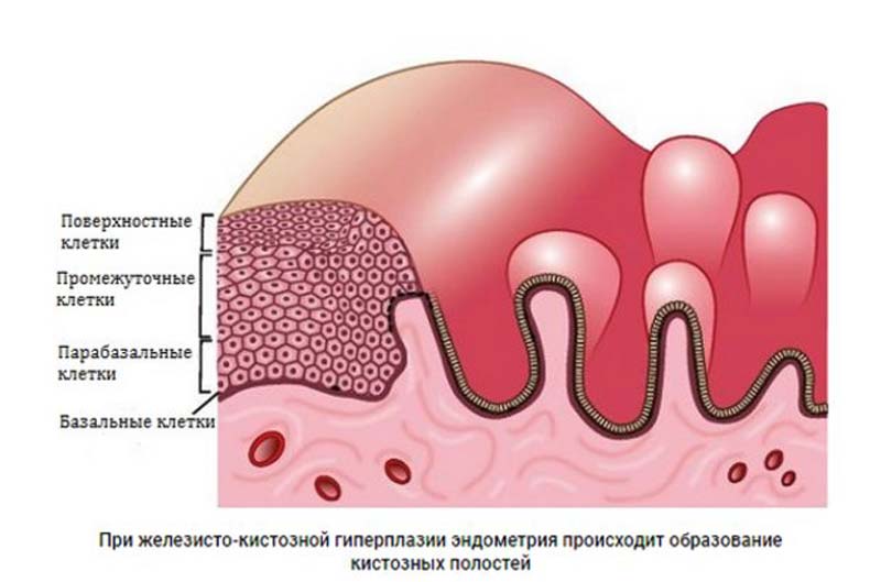 железисто-кистозная гиперплазия