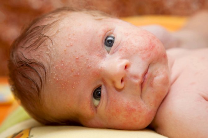 Аллергия на коже у взрослых и детей