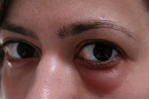 Причины отеков кожи вокруг глаз