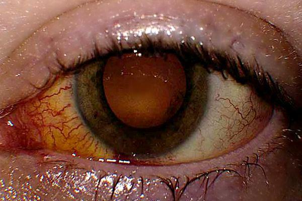 Глаз с патологией хориоретинит