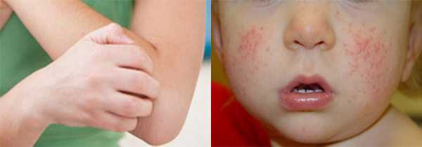 Аллергия на киви