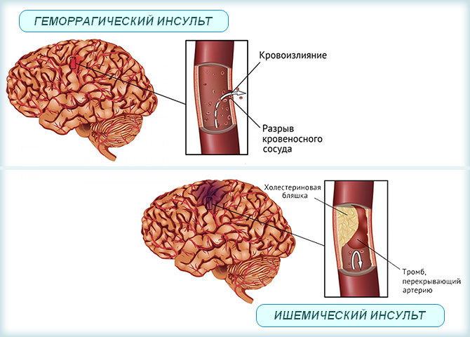 Ишемический и геморрагический инсульт