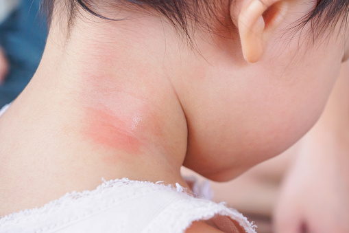 Как проявляется аллергия на укусы комаров у взрослых и детей?