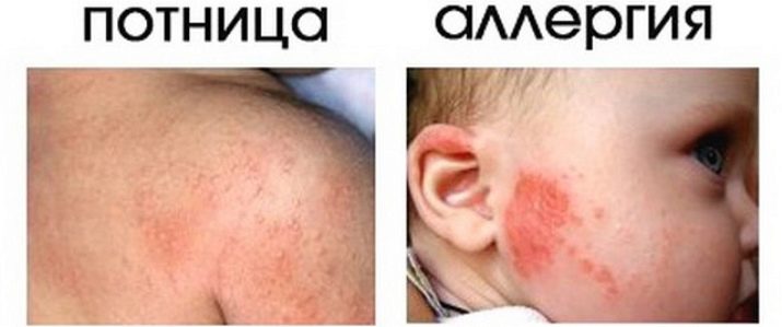 Как отличить потницу от аллергии