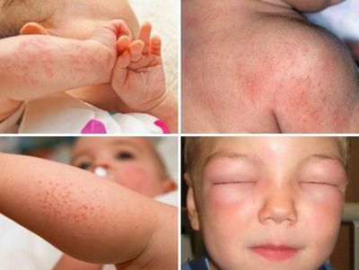 Аллергия на березу у ребенка