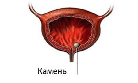 Признаки и методы лечения мочекаменной болезни у мужчины