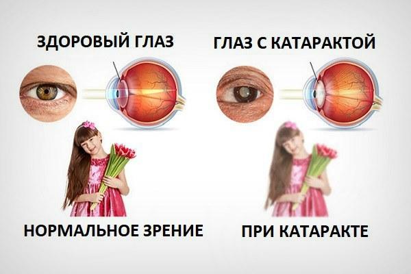 Лечение катаракты