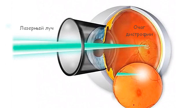Лазерная коагуляция сетчатки глаза