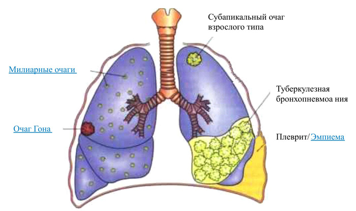 Плеврит