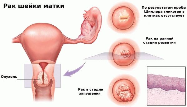 рак шейки матки