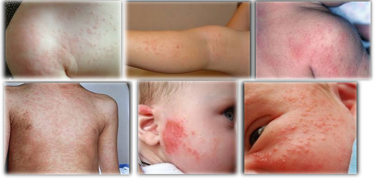 Аллергия на Парацетамол