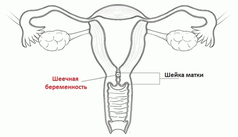 шеечная беременность