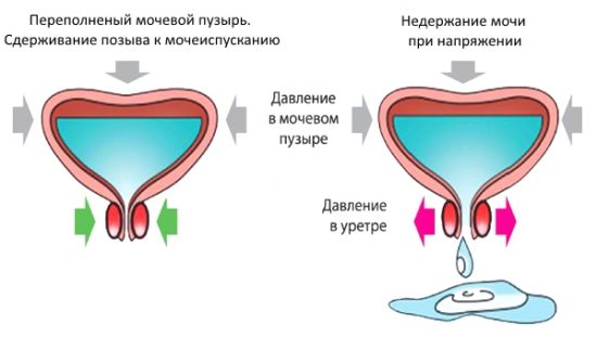 Как проводится катетеризация мочевого пузыря у женщин и мужчин?