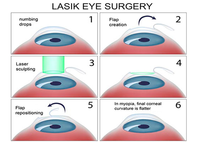 Что не следует делать после лазерной операции на глаза