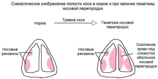 Гематома носовой перегородки на схеме