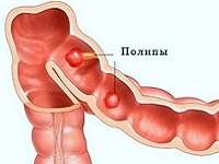 Почему образуются полипы в кишечнике