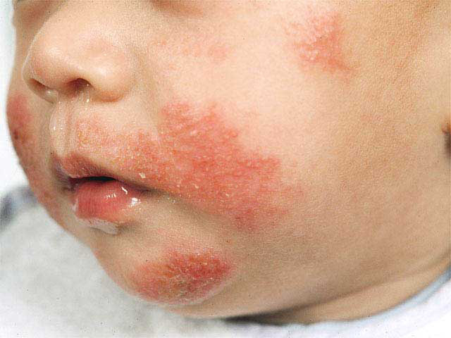 Аллергия на тыкву