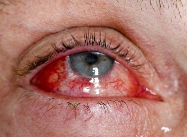 Болезнь глаз эндофтальмит