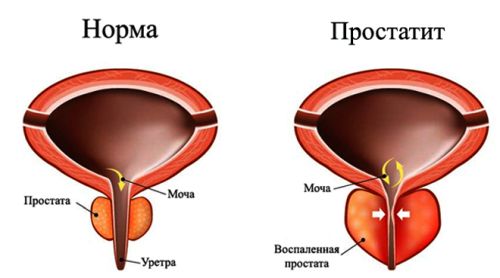 Лейкоциты в моче у мужчин норма, причины повышения