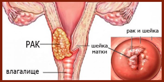 Рак шейки матки 3 стадия