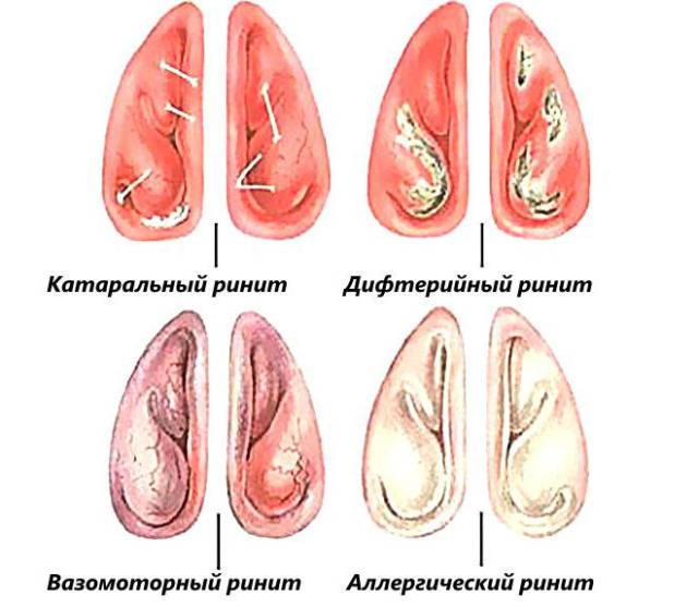 Отечность пазух носа при различных видах ринита